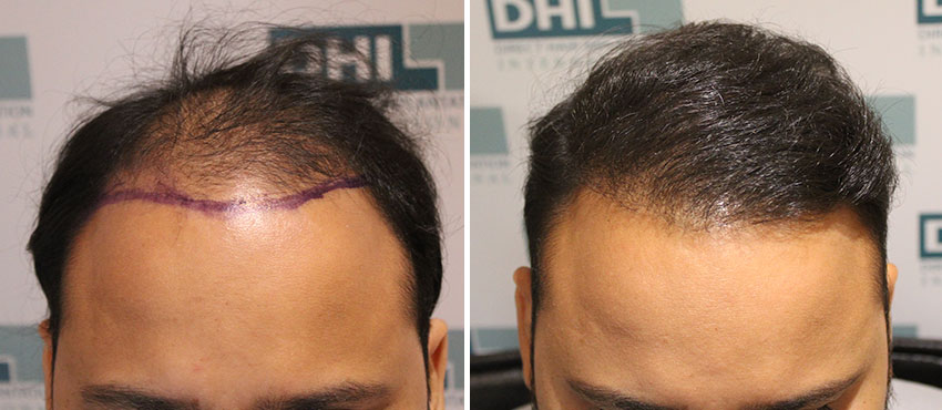 DHI before & after hair transplant results