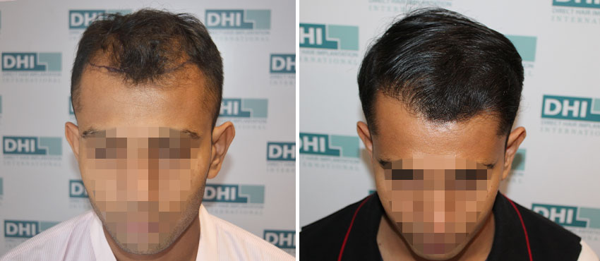 DHI before & after hair transplant results