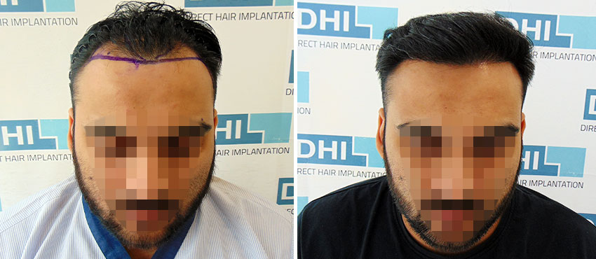 DHI before & after hair transplant results