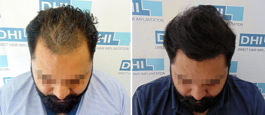 DHI before & after hair transplant results