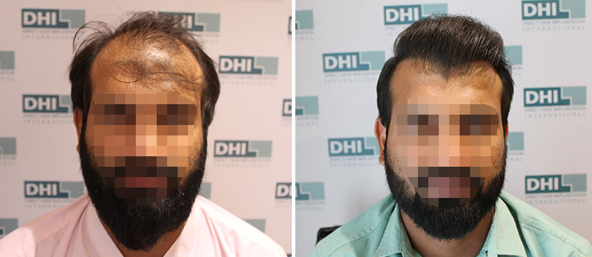 DHI before & after hair transplant results