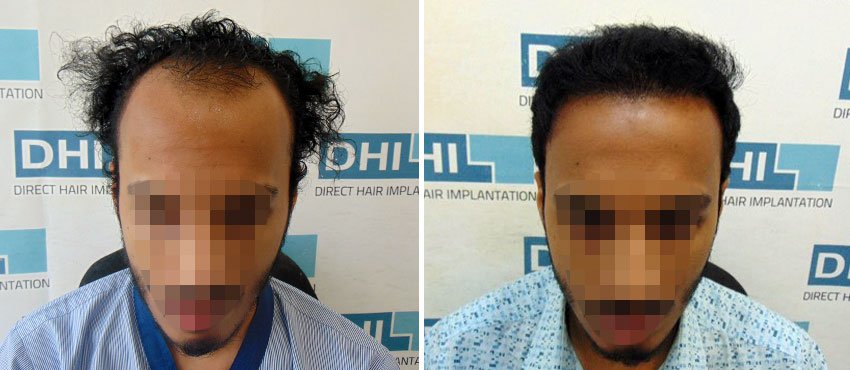 DHI before & after hair transplant results