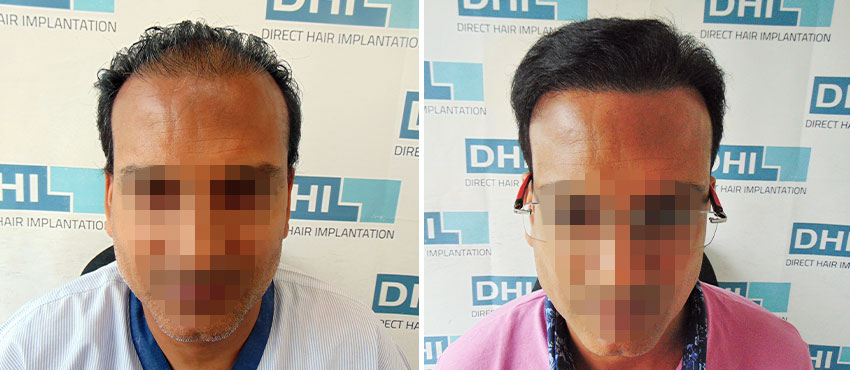 DHI before & after hair transplant results