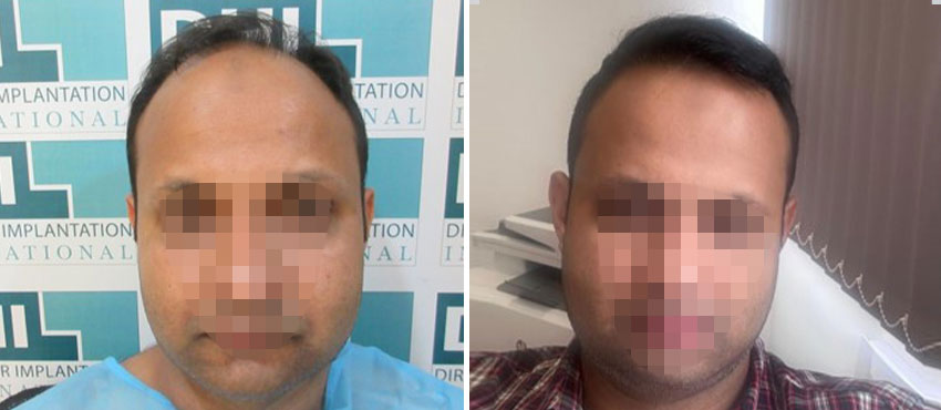 DHI before & after hair transplant results