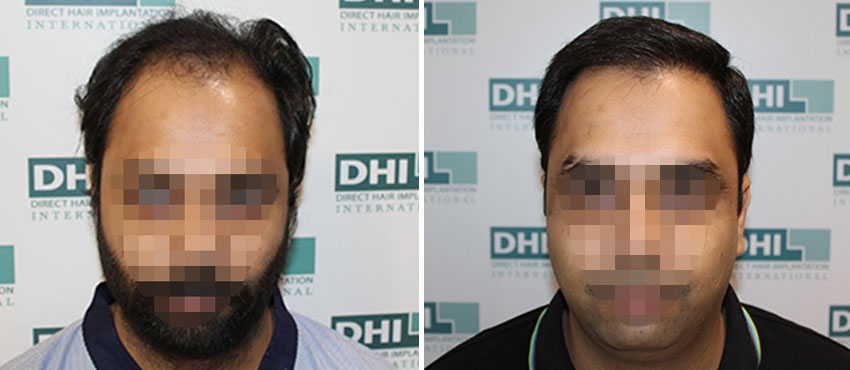 DHI before & after hair transplant results