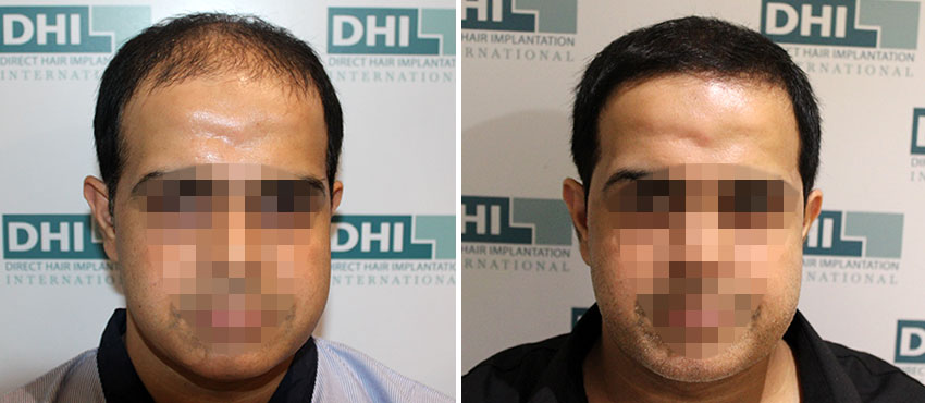 DHI before & after hair transplant results