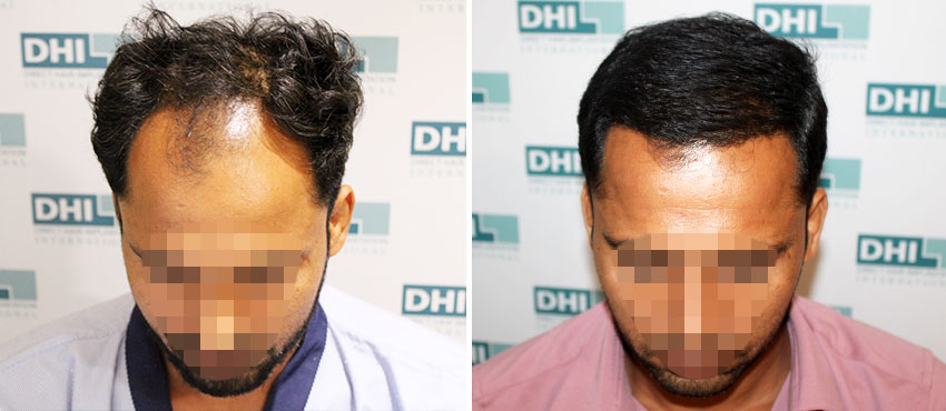 DHI before & after hair transplant results