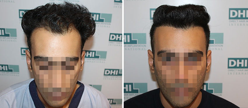 DHI before & after hair transplant results