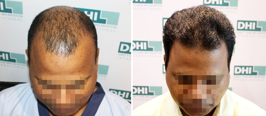 DHI before & after hair transplant results