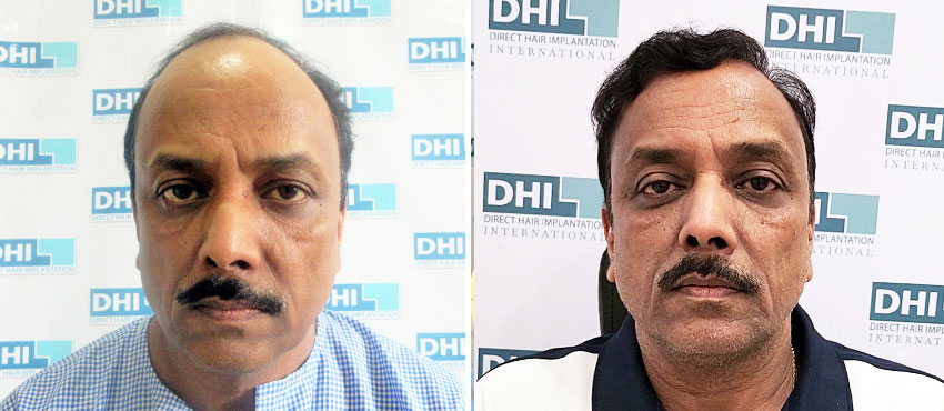 DHI before & after hair transplant results