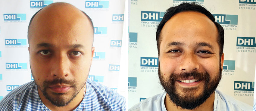 DHI before & after hair transplant results