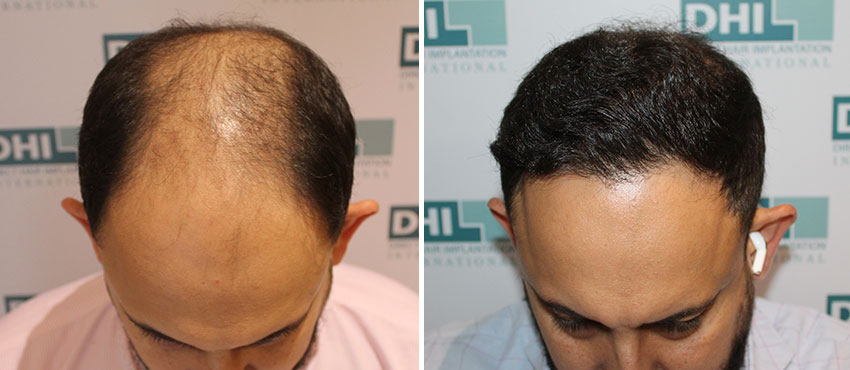 DHI before & after hair transplant results