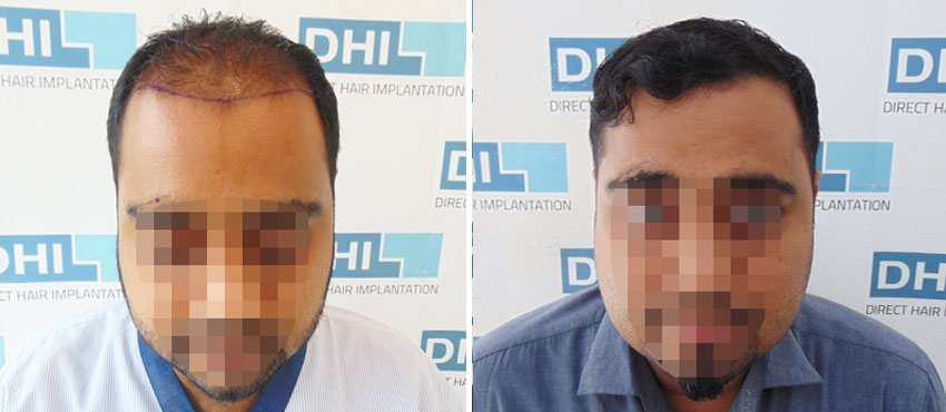 DHI before & after hair transplant results