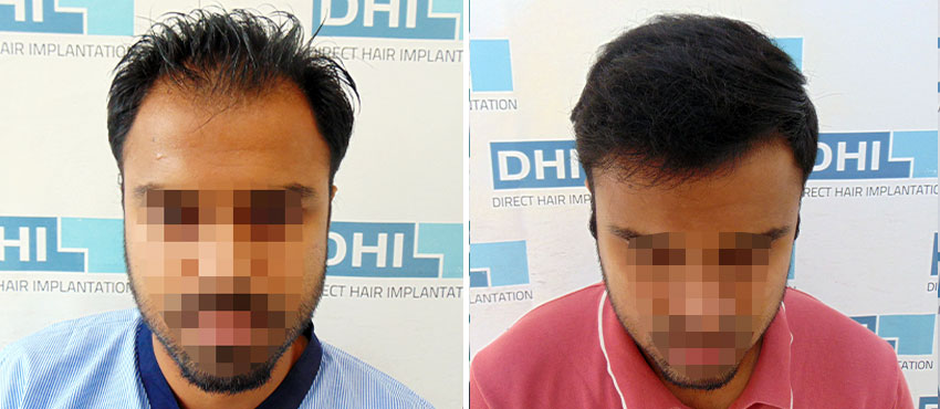 DHI before & after hair transplant results