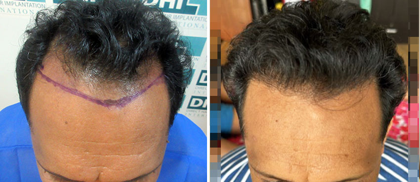 DHI before & after hair transplant results