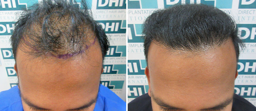 DHI before & after hair transplant results