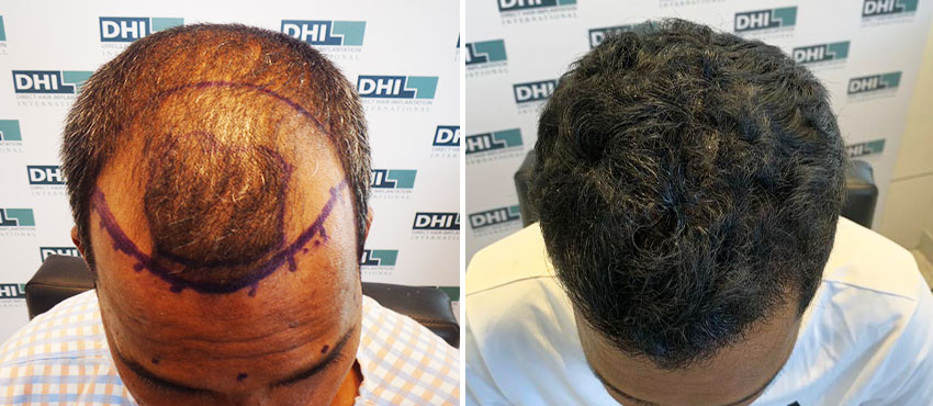 DHI before & after hair transplant results