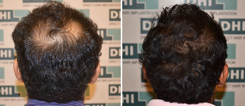 DHI before & after hair transplant results