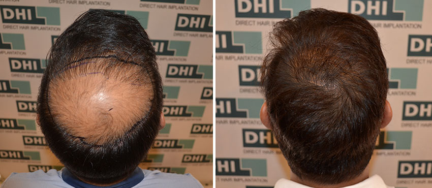 DHI before & after hair transplant results