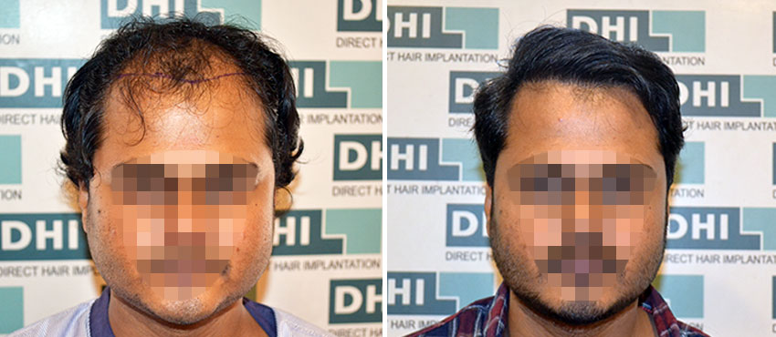 DHI before & after hair transplant results