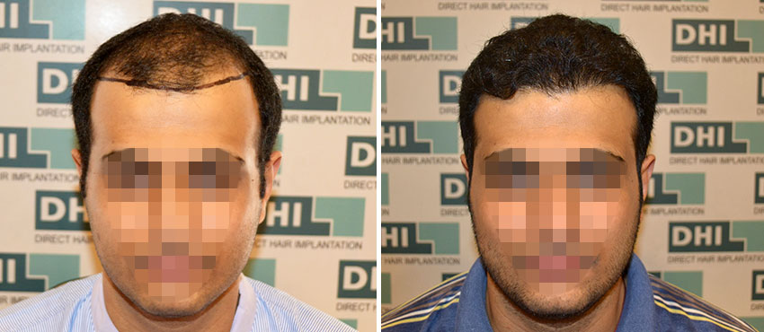 DHI before & after hair transplant results