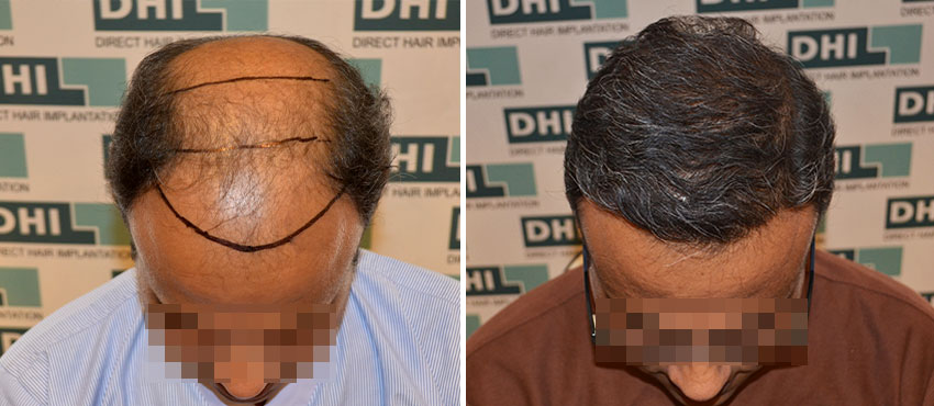 DHI before & after hair transplant results