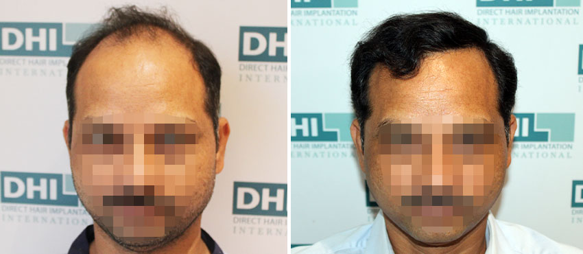 DHI before & after hair transplant results