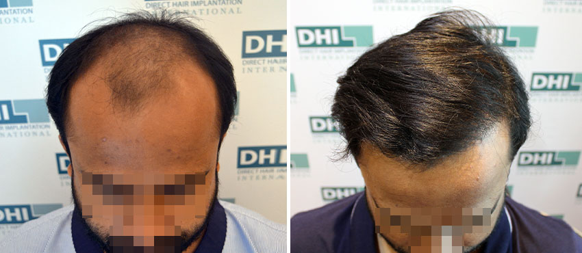 DHI before & after hair transplant results