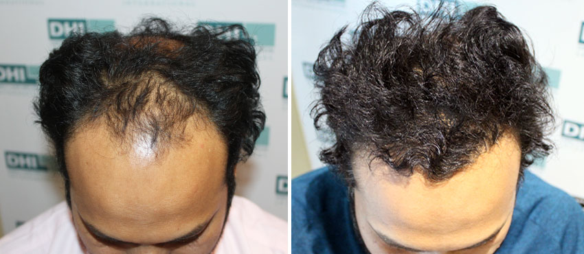 DHI before & after hair transplant results