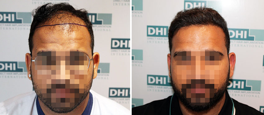 DHI before & after hair transplant results