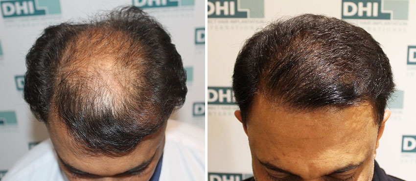 DHI before & after hair transplant results