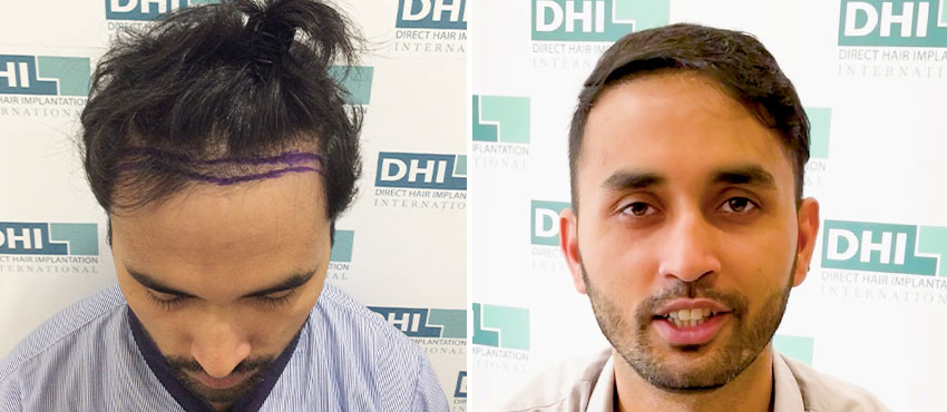 DHI before & after hair transplant results