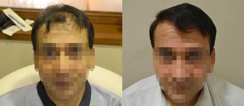 DHI before & after hair transplant results