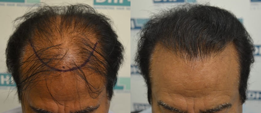 DHI before & after hair transplant results