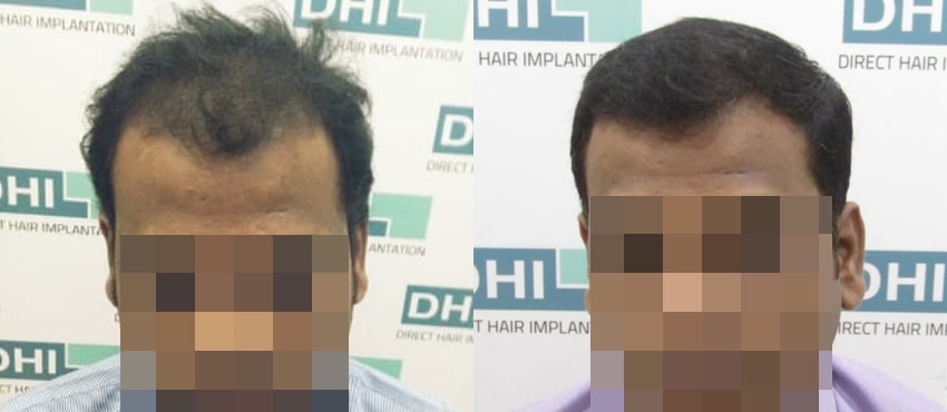 DHI before & after hair transplant results