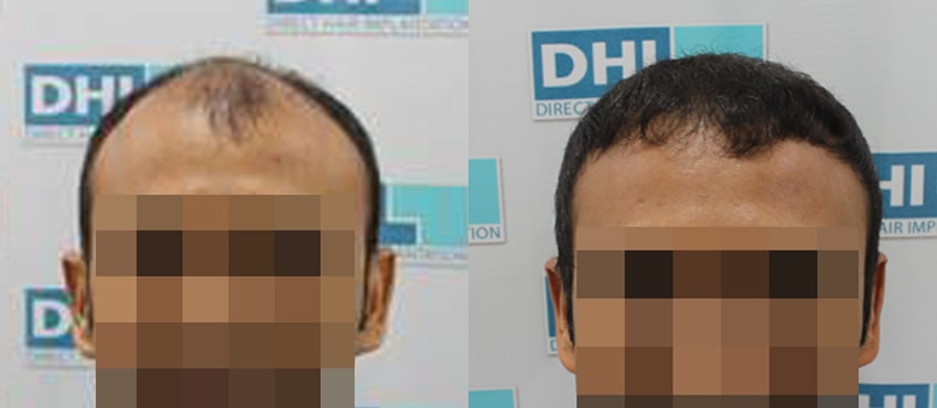 DHI before & after hair transplant results