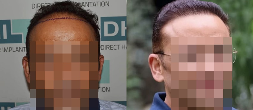 DHI before & after hair transplant results