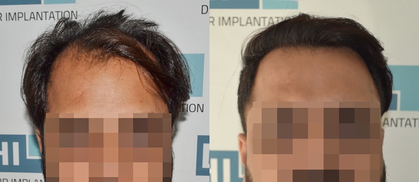 DHI before & after hair transplant results