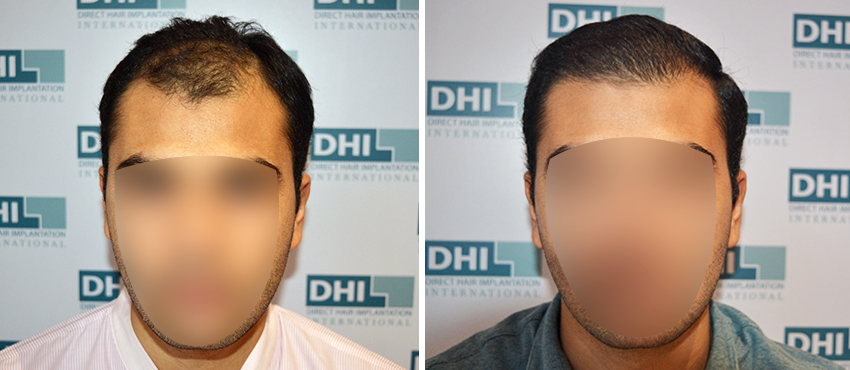 DHI before & after hair transplant results