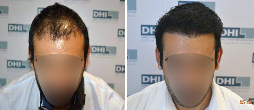 DHI before & after hair transplant results