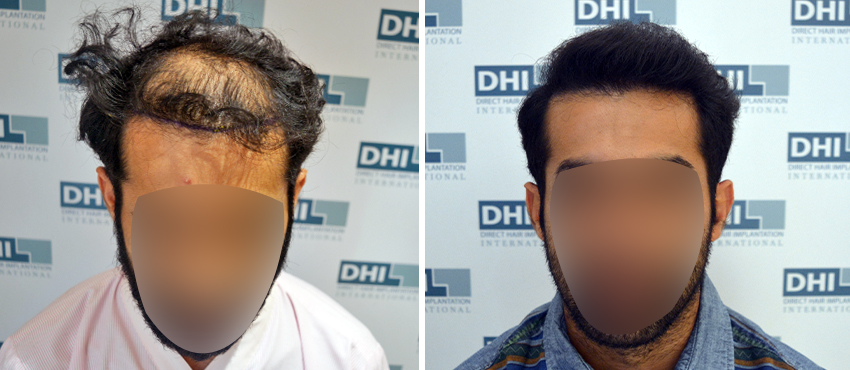 DHI before & after hair transplant results