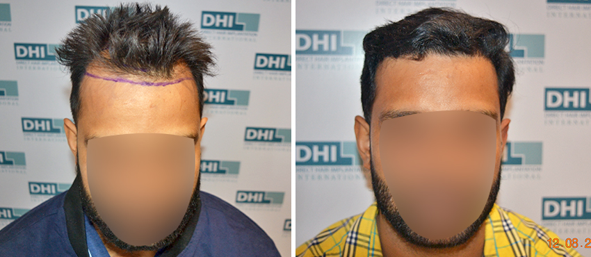 DHI before & after hair transplant results