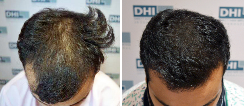 DHI before & after hair transplant results