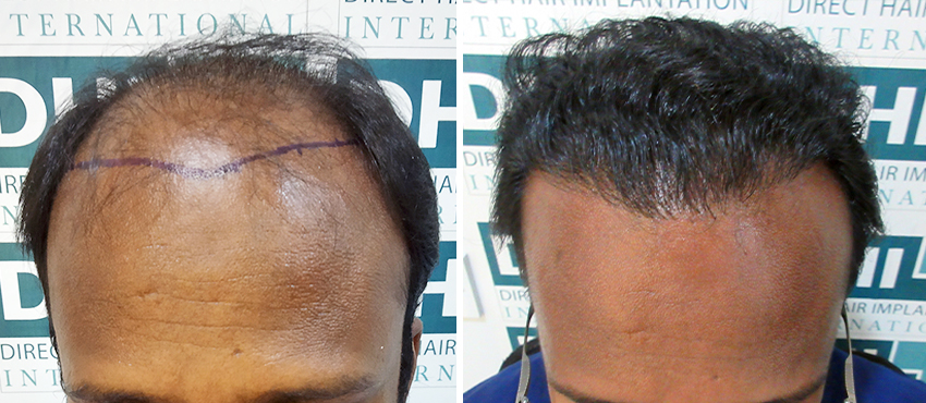 DHI before & after hair transplant results