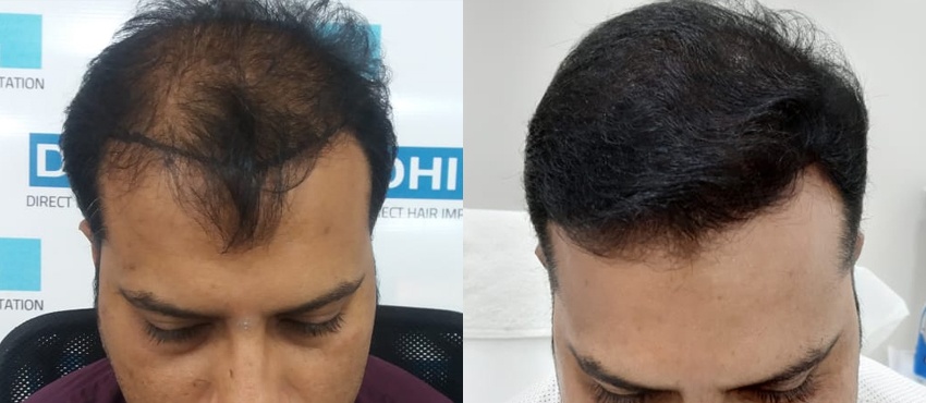 DHI before & after hair transplant results