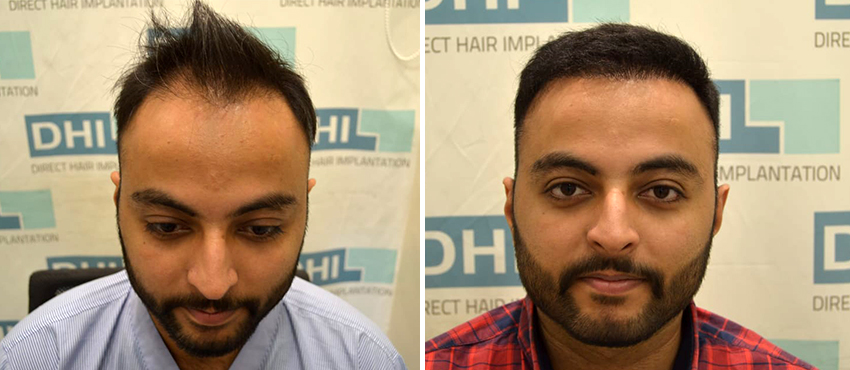 Best Hair Transplant in Mumbai: No. 1 Hair Clinic in India by Ranveer Singh  - Issuu