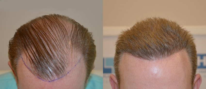 DHI before & after hair transplant results