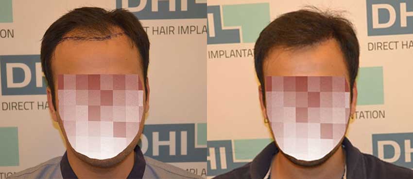 DHI before & after hair transplant results