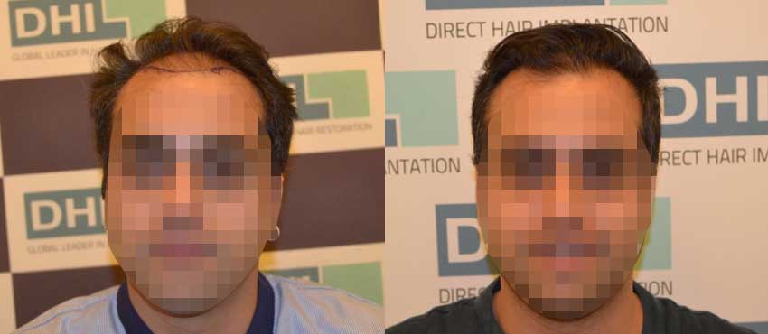 DHI before & after hair transplant results