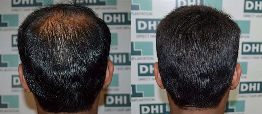 DHI before & after hair transplant results